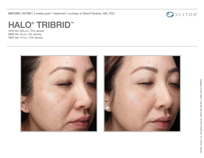 TRIBRID before and after - 3 weeks post 1 treatment
