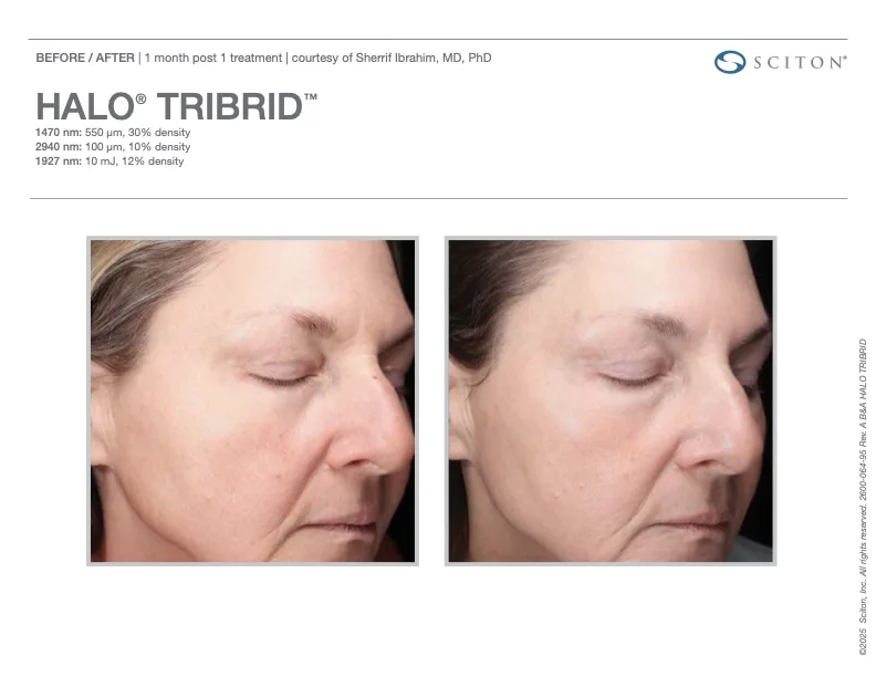 TRIBRID before and after - 1 month post 1 treatment