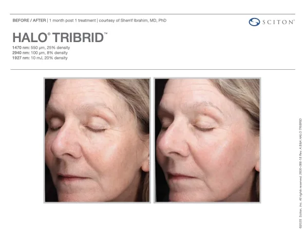 TRIBRID before and after - 1 month post treatment